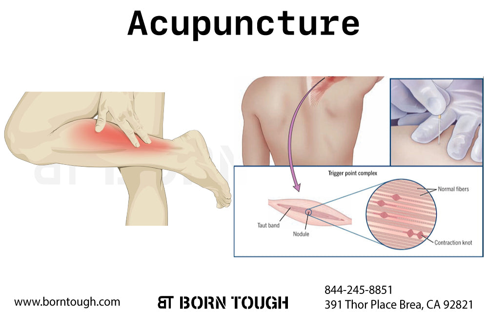 Acupuncture