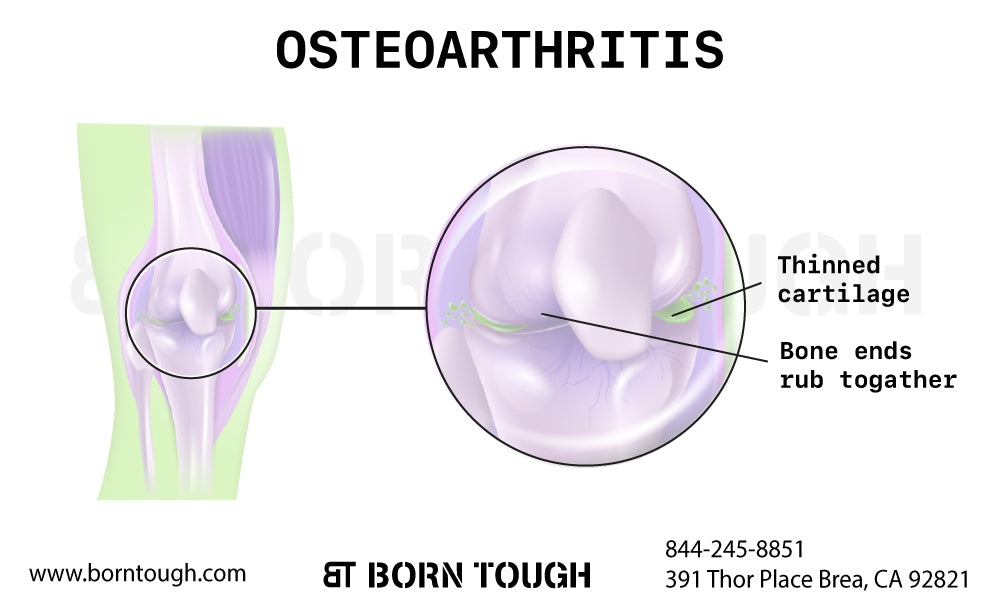 Osteoarthritis (Joint Pain)