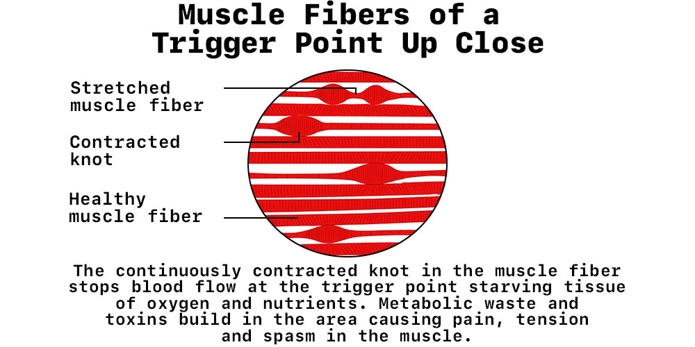 What Are Muscle Knots (Myofascial Trigger Points)