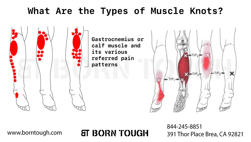 What Are the Types of Muscle Knots